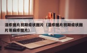 湿疹图片初期症状图片（湿疹图片初期症状图片荨麻疹图片）